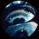 Angle Recession, Gonioscopy Angle Recession, Gonioscopy
